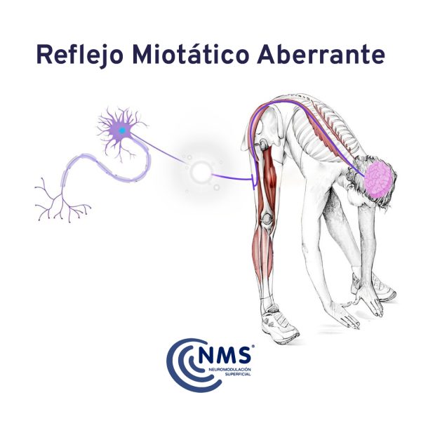 Reflejo Miotático Aberrante
